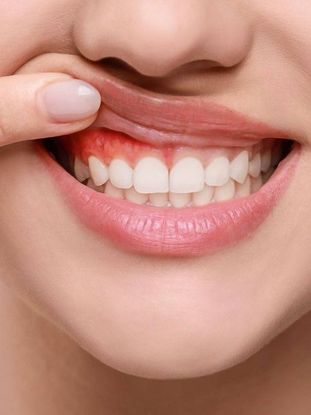 gum care in chromepet and hasthinapuram
