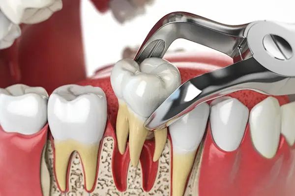 painless tooth extraction in chromepet,hasthinapuram,chitlapakkam