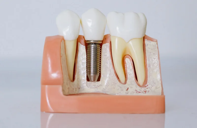 Dental implant in chromepet and chitlapakkam area